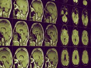 Alzheimer için umut veren lityum hafızayı geri getirir mi?