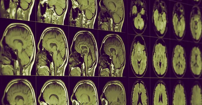 Alzheimer için umut veren lityum hafızayı geri getirir mi?